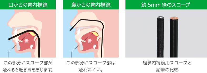 経鼻（鼻から挿入する）胃カメラ検査