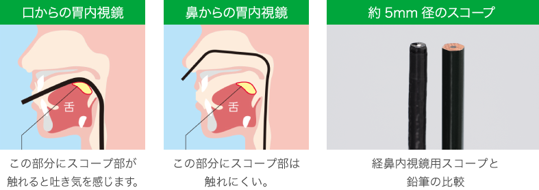 経鼻(鼻から挿入する)胃カメラ検査